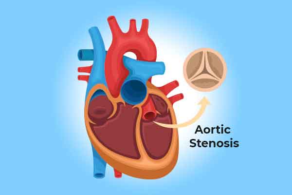 AORTIC VALVE STENOSIS