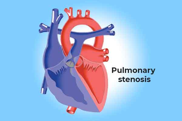 PULMONARY STENOSIS