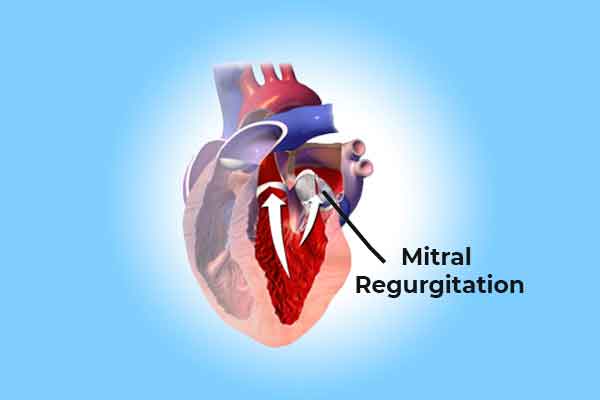 MITRAL VALVE REGURGITATION