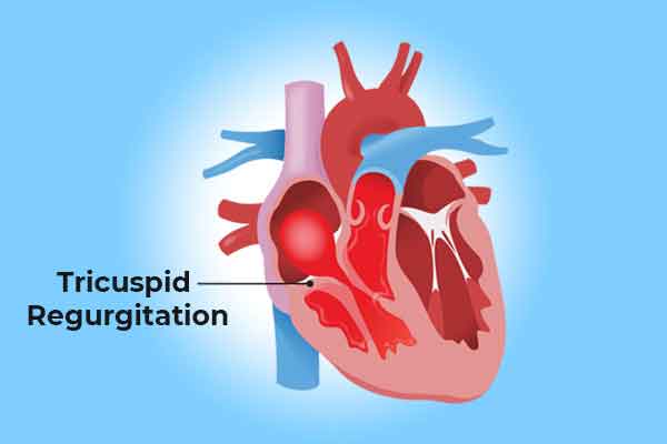 TRICUSPID VALVE REGURGITATION