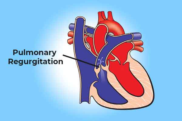 PULMONARY REGURGITATION